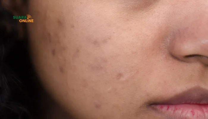 5 Penyebab Kulit Muka Kusam dan Berjerawat