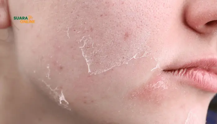 7 Cara Mengatasi Kulit Kering Agar Lebih Percaya Diri