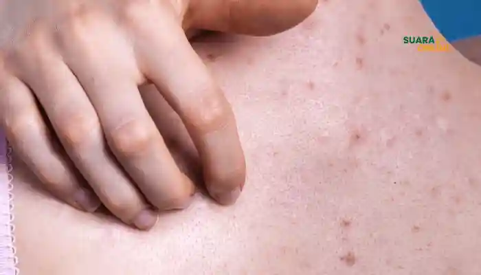 8 Penyebab Jerawat Punggung dan Cara Mengatasinya